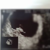 Ayuda con método ramzi: niño o niña? - 1