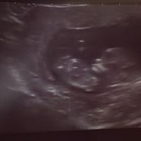 Ayuda con método ramzi: niño o niña? - 1