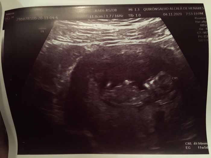 Ayuda con método ramzi: niño o niña? - 1