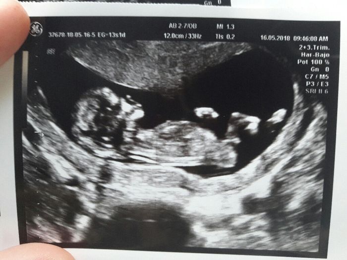 Tubérculo genital niño o niña??? 1