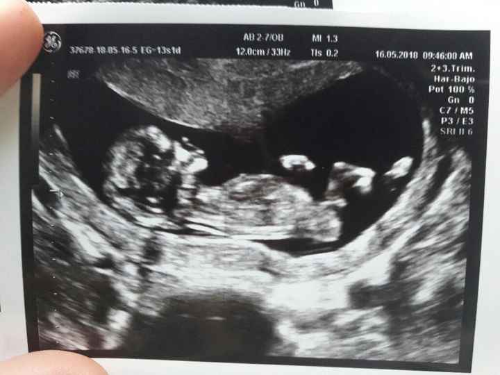 Tubérculo genital niño o niña??? - 1