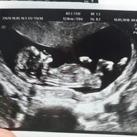 Tubérculo genital niño o niña??? - 1