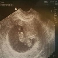 Ayuda con método ramzi: niño o niña? - 1