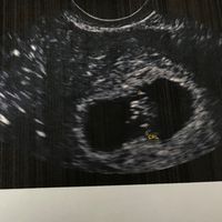 Ayuda con método ramzi: niño o niña? - 2