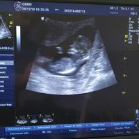 Ayuda con método ramzi: niño o niña? - 1