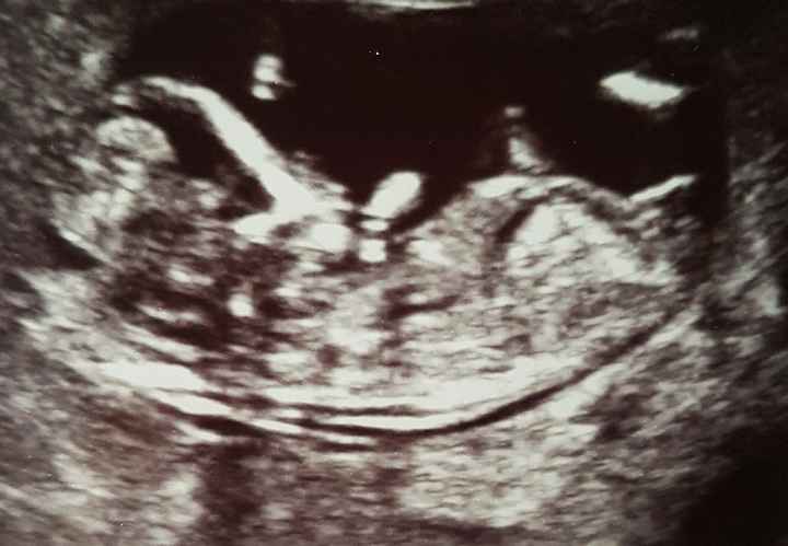 Ayuda con método ramzi: niño o niña? - 1