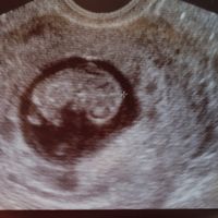 Ayuda con método ramzi: niño o niña? - 1