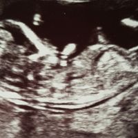 Ayuda con método ramzi: niño o niña? - 1