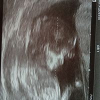 Ayuda con método ramzi: niño o niña? - 1