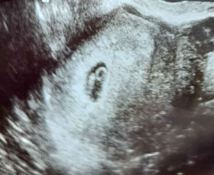 Ayuda con método ramzi: niño o niña? - 1