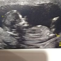 Tubérculo genital niño o niña??? - 1