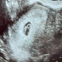 Ayuda con método ramzi: niño o niña? - 1