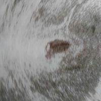 Buscadoras con síndrome de ovario poliquístico (sop) - 1