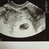 Ayuda con método ramzi: niño o niña? - 1