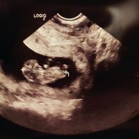 Ayuda con método ramzi: niño o niña? - 1