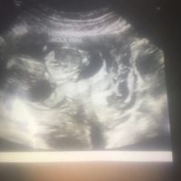 12 semanas... Niño o niña? - 1