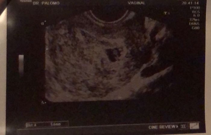 Ayuda con método ramzi: niño o niña? - 1