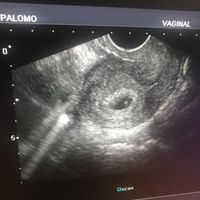 Ayuda con método ramzi: niño o niña? - 1