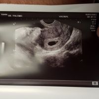 Ayuda con método ramzi: niño o niña? - 1