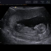  Ecografias primer trimestre: niña o niño? - 1