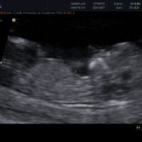  Ecografias primer trimestre: niña o niño? - 2