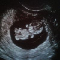 Ayuda con método ramzi: niño o niña? - 2
