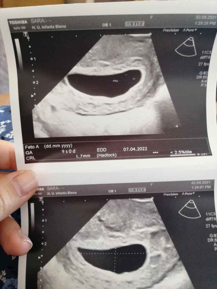 Embrión muy pequeño para 9 semanas - 1
