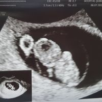 Ayuda con método ramzi: niño o niña? - 3