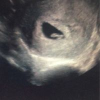 Ayuda con método ramzi: niño o niña? - 1