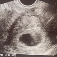 Ayuda con método ramzi: niño o niña? - 1
