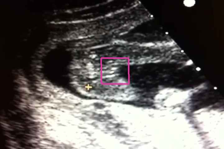18 semanas