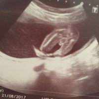 Ayuda con método ramzi: niño o niña? - 1