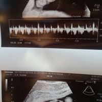 Ayuda con método ramzi: niño o niña? - 1