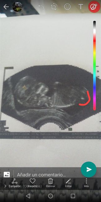 Tubérculo genital: niña - 1