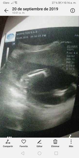 Tubérculo genital: niña - 1