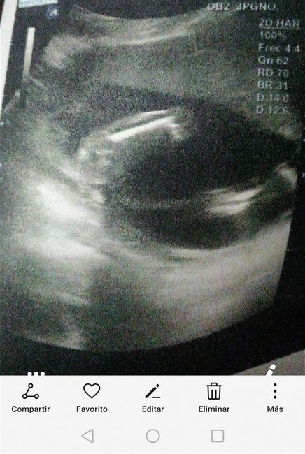Tubérculo genital: niña - 1