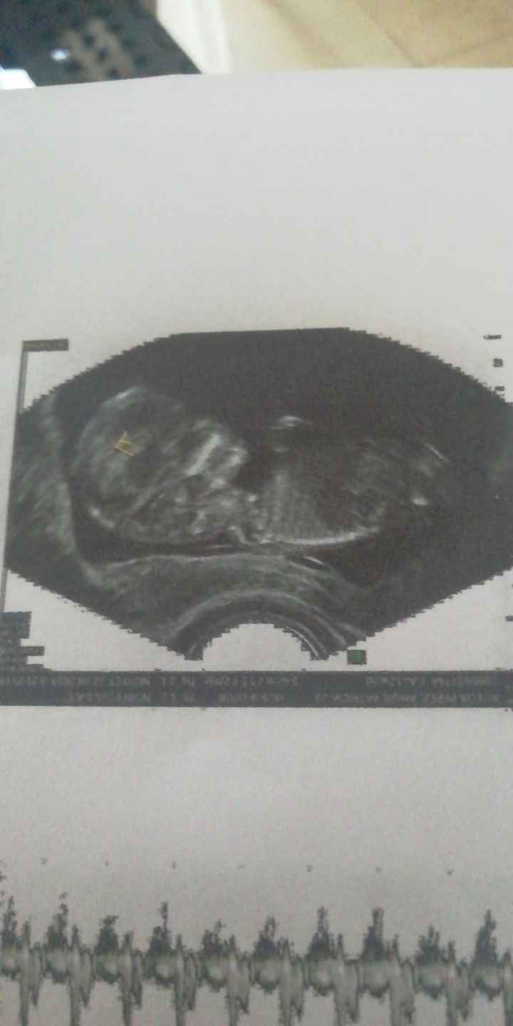 Tubérculo genital: niña - 1