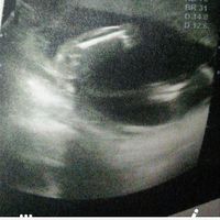 Tubérculo genital: niña - 1