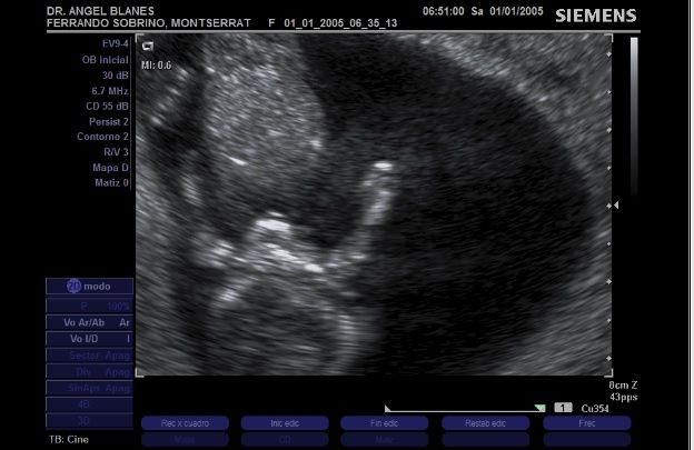 Cabecita y brazos 11 semanas
