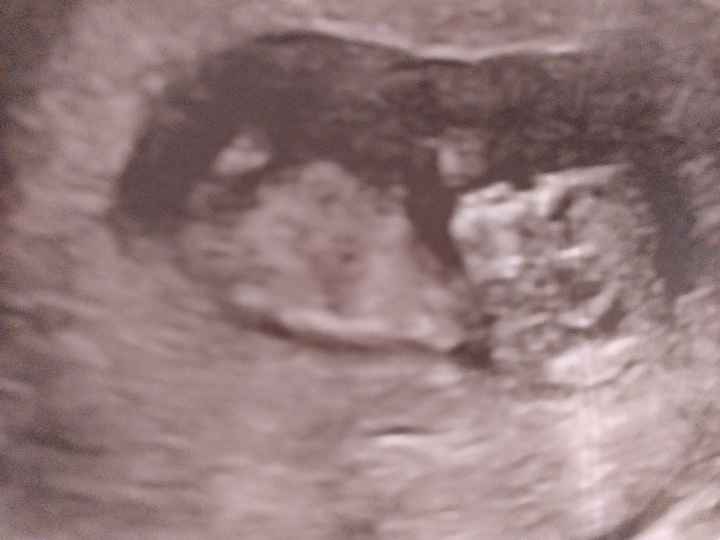 Ayuda con método ramzi: niño o niña? - 1