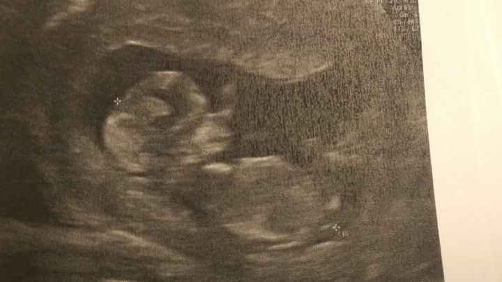 Ayuda con método ramzi: niño o niña? - 1
