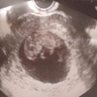 Ayuda con método ramzi: niño o niña? - 1