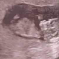Ayuda con método ramzi: niño o niña? - 1