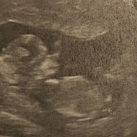 Ayuda con método ramzi: niño o niña? - 1