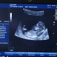 Ayuda con método ramzi: niño o niña? - 1