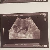Ayuda con método ramzi: niño o niña? - 1