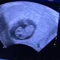 Ayuda con método ramzi: niño o niña? - 1