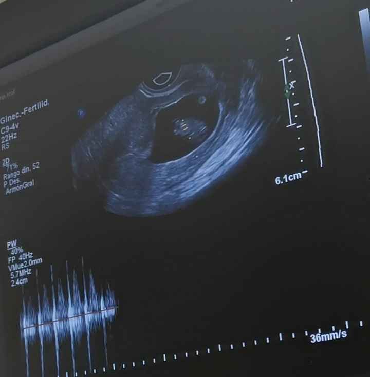 Ayuda con método ramzi: niño o niña? 24