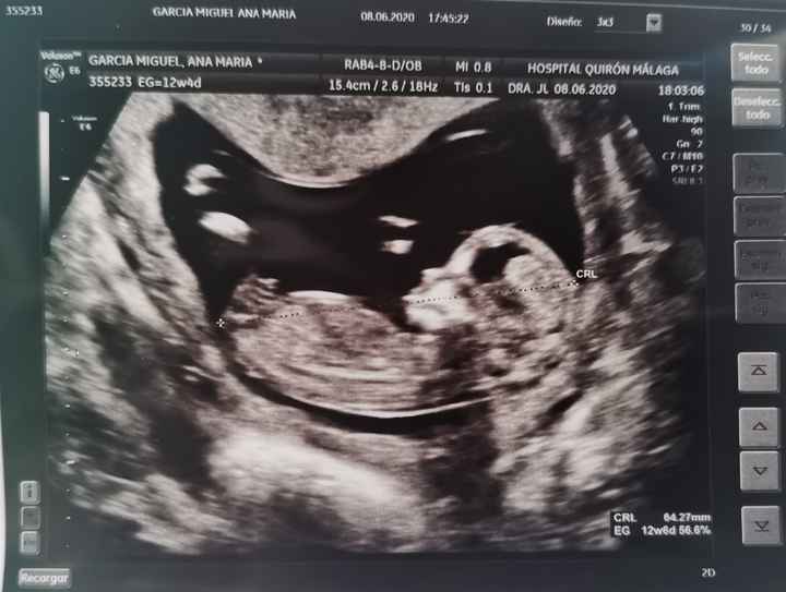 Tubérculo genital, ¿niño o niña? 3