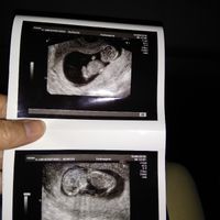 Ayuda con método ramzi: niño o niña? - 1